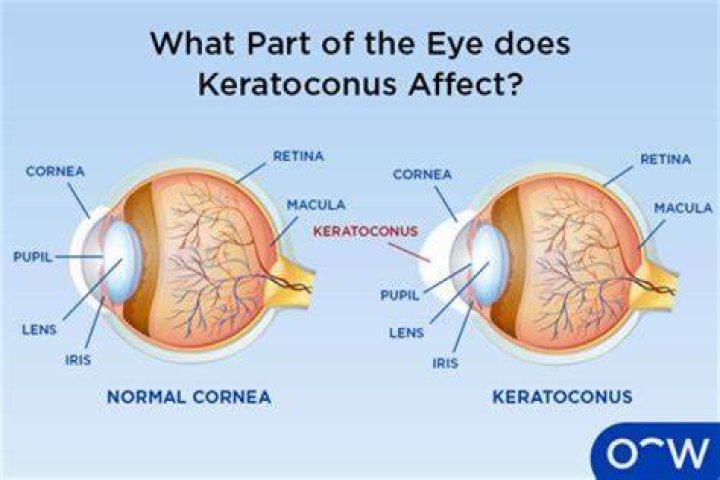 Can I get disability for keratoconus?